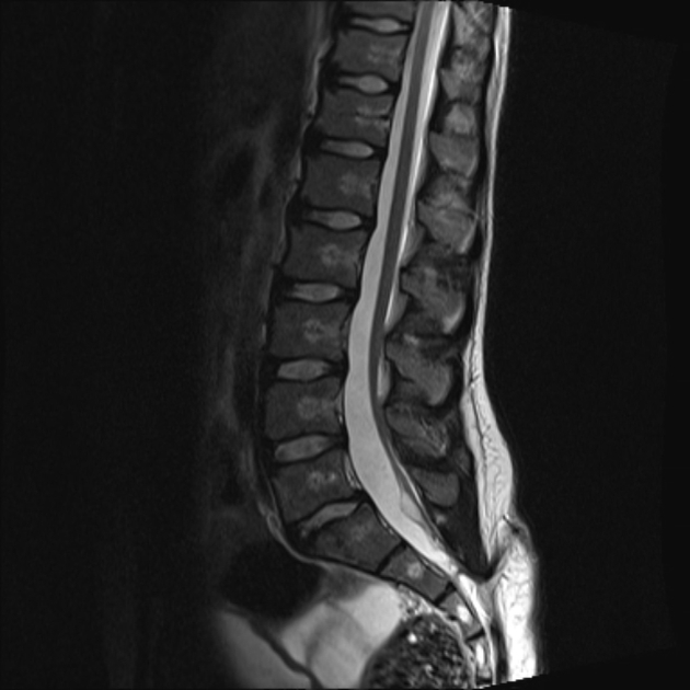 MRI of the lumbar spine